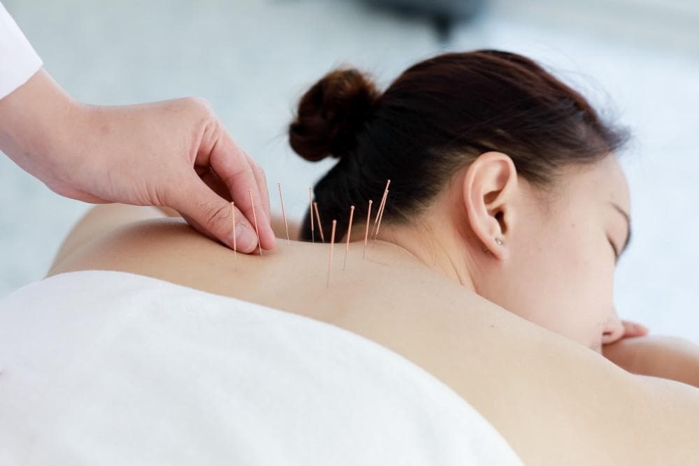 Acupuncture Acupuncture